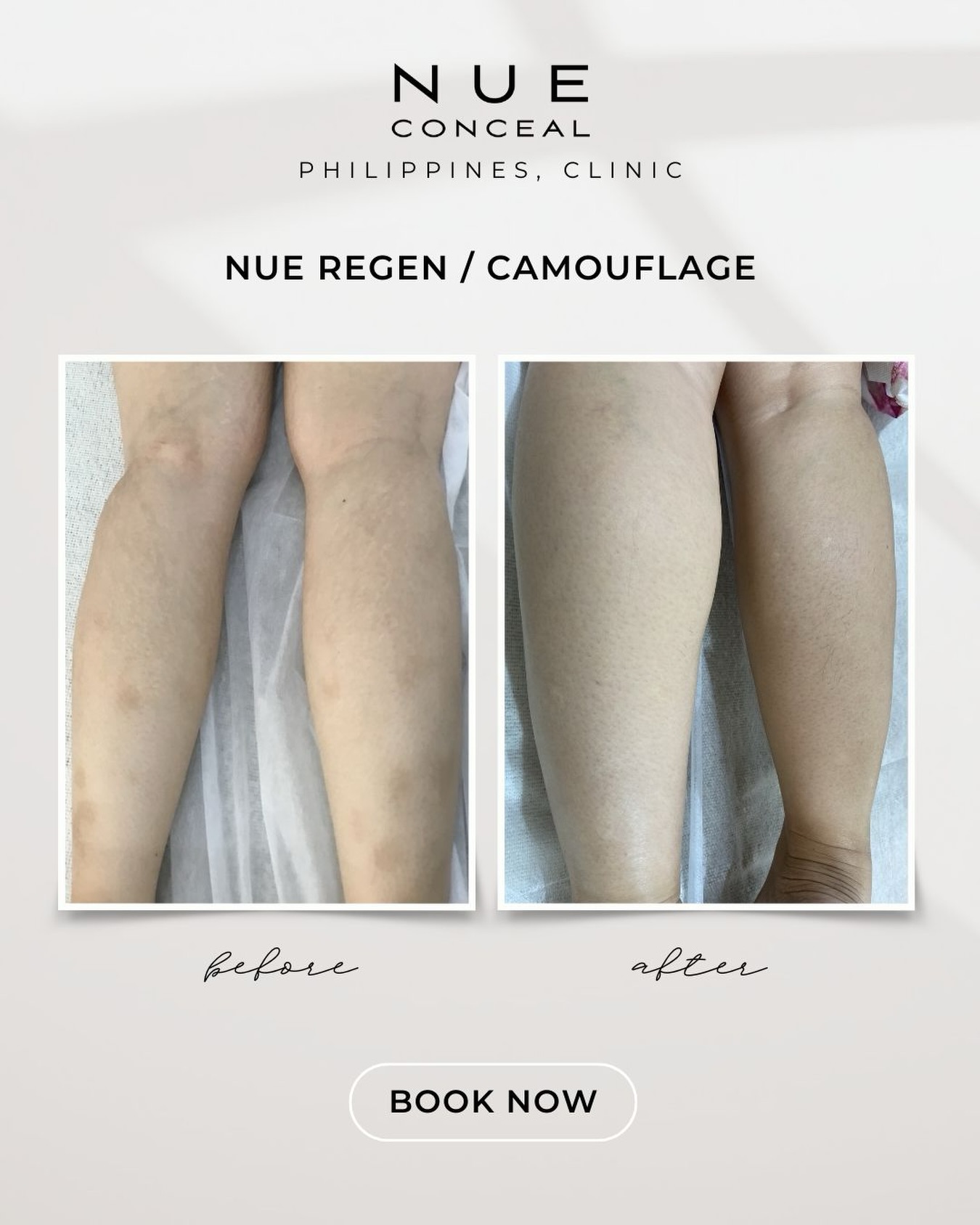 Nue Conceal PH Facebook ad: This transformation was achieved through a customized…
