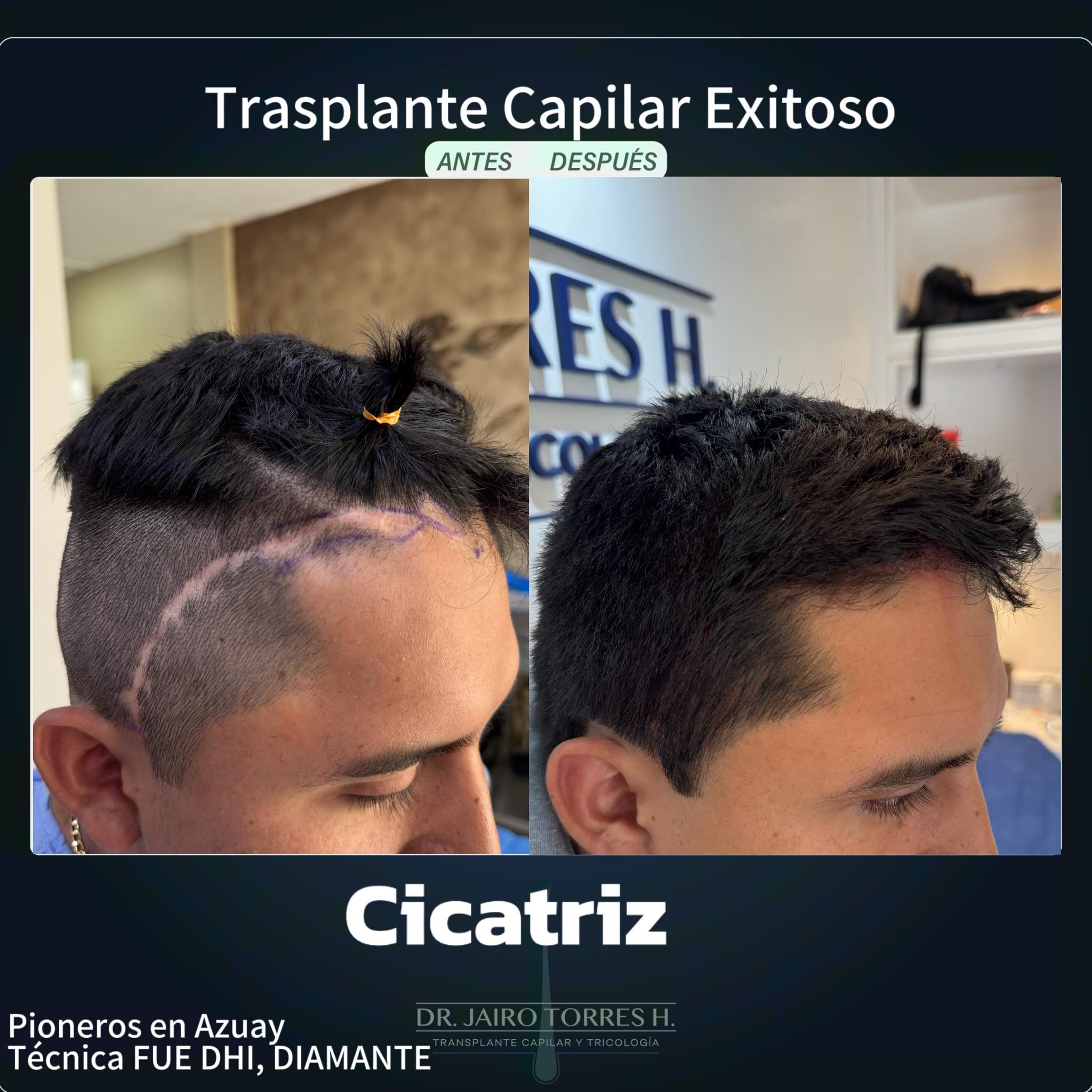 Dr Jairo Torres H Facebook ad: ****TRASPLANTE CAPILAR EXITOSO***