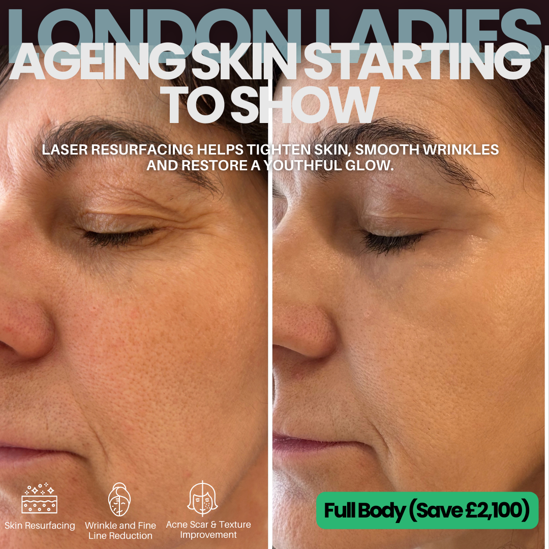 Pulse Laser Aesthetic Clinic - London Facebook ad: Up to 50% OFF CO2 Laser Skin Resurfacing