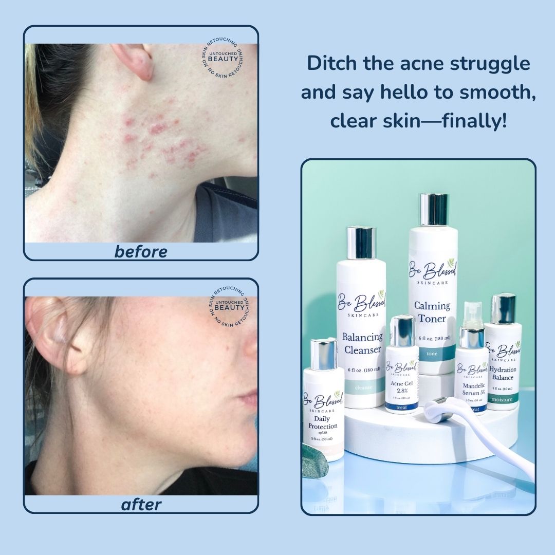 Be Blessed Skin Care Facebook ad: Professional-Grade Results for Persistent Acne