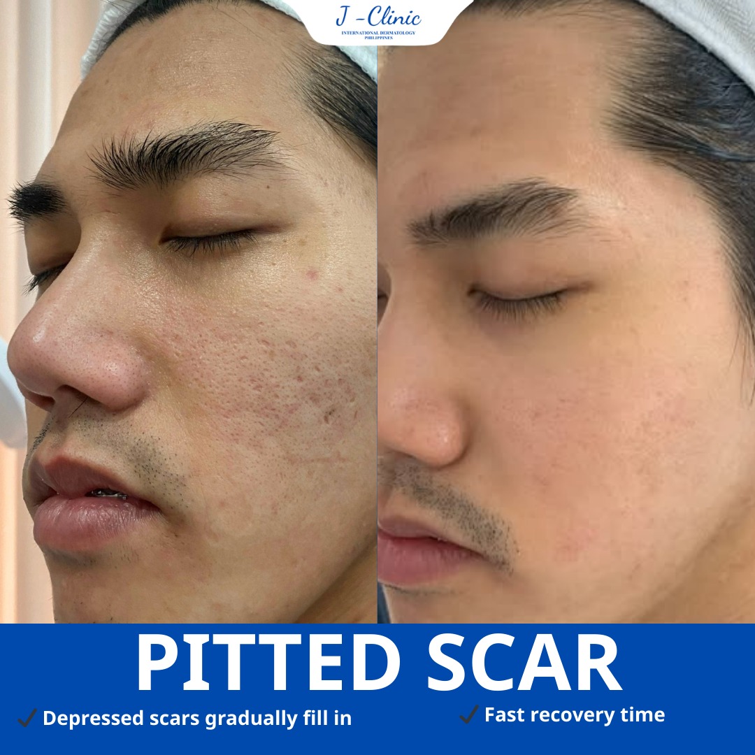 Handbag Facebook ad: PITTED SCAR TREATMENT, REVEAL SMOOTHER SKIN AFTER JUST…