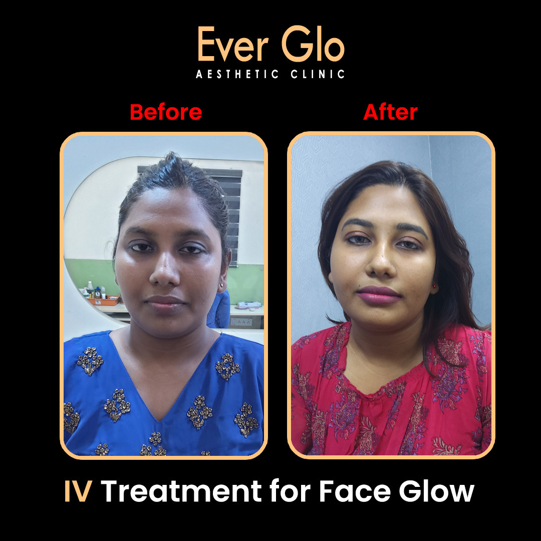 Everglo Aesthetics Velachery Facebook ad: Skin/ Hair/ Laser/ Weight Loss