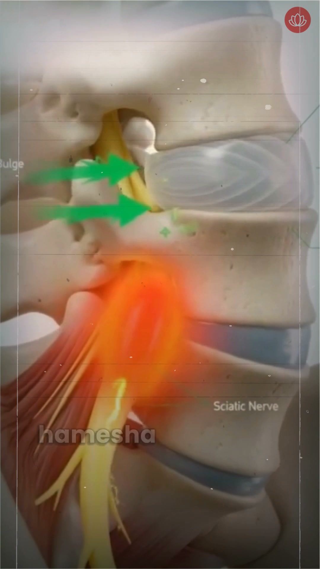 Doctor's Diary Facebook ad: The 3-Stage Fix for Sciatica Nerve Pain
