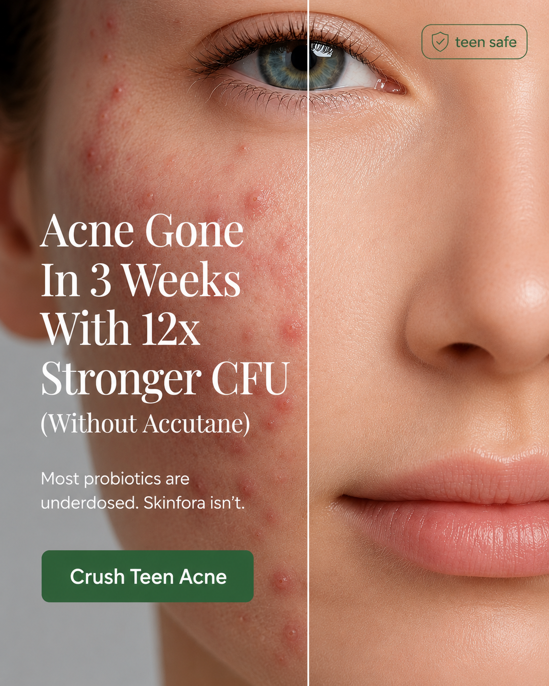 Skinfora Facebook ad: The Only Teen Safe Acne Probiotics