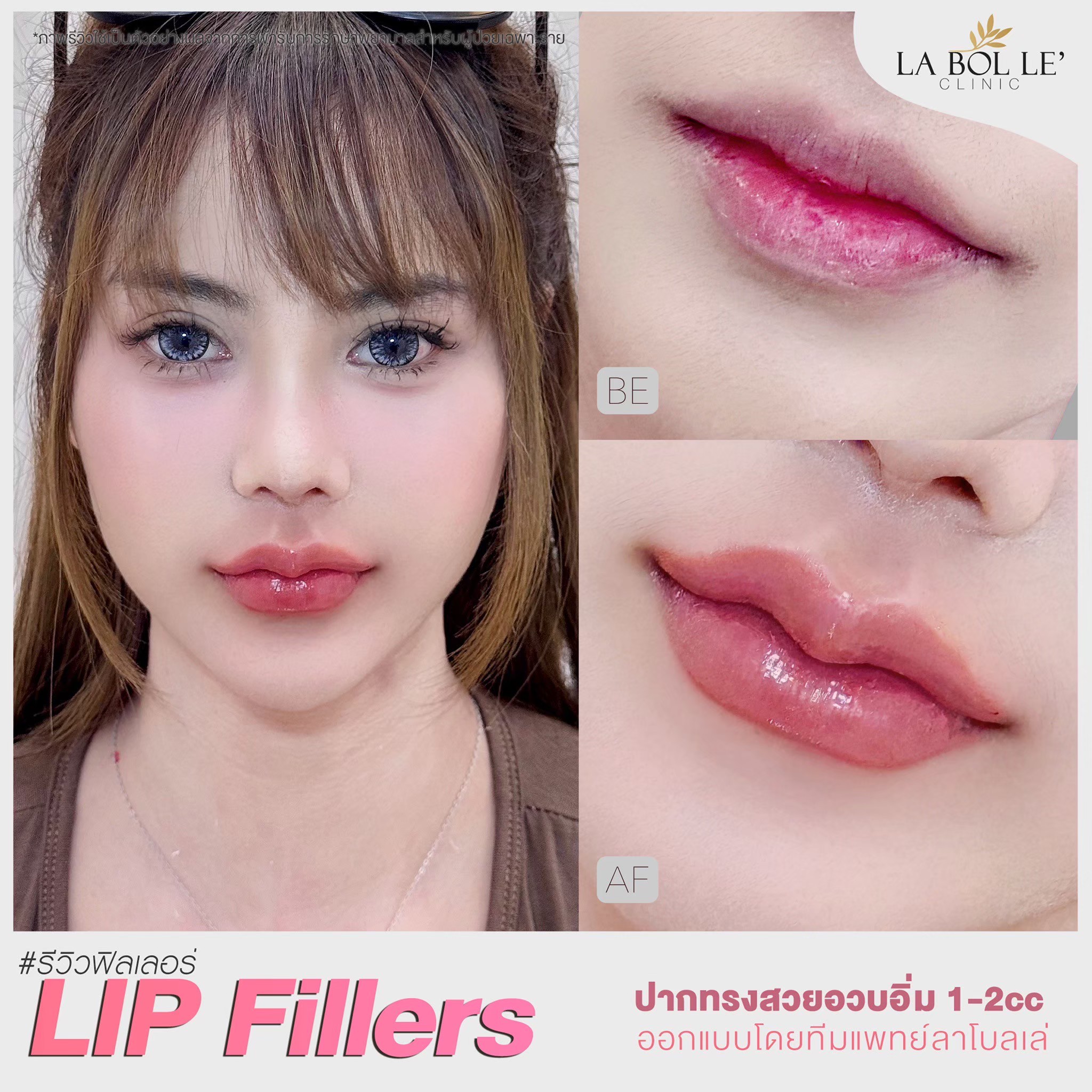 Labolle’ Clinic ฟิลเลอร์ ดอลลี่อาย Dolly Eyes Facebook ad: ปากเหี่ยว ปากตกร่อง หลบไป!