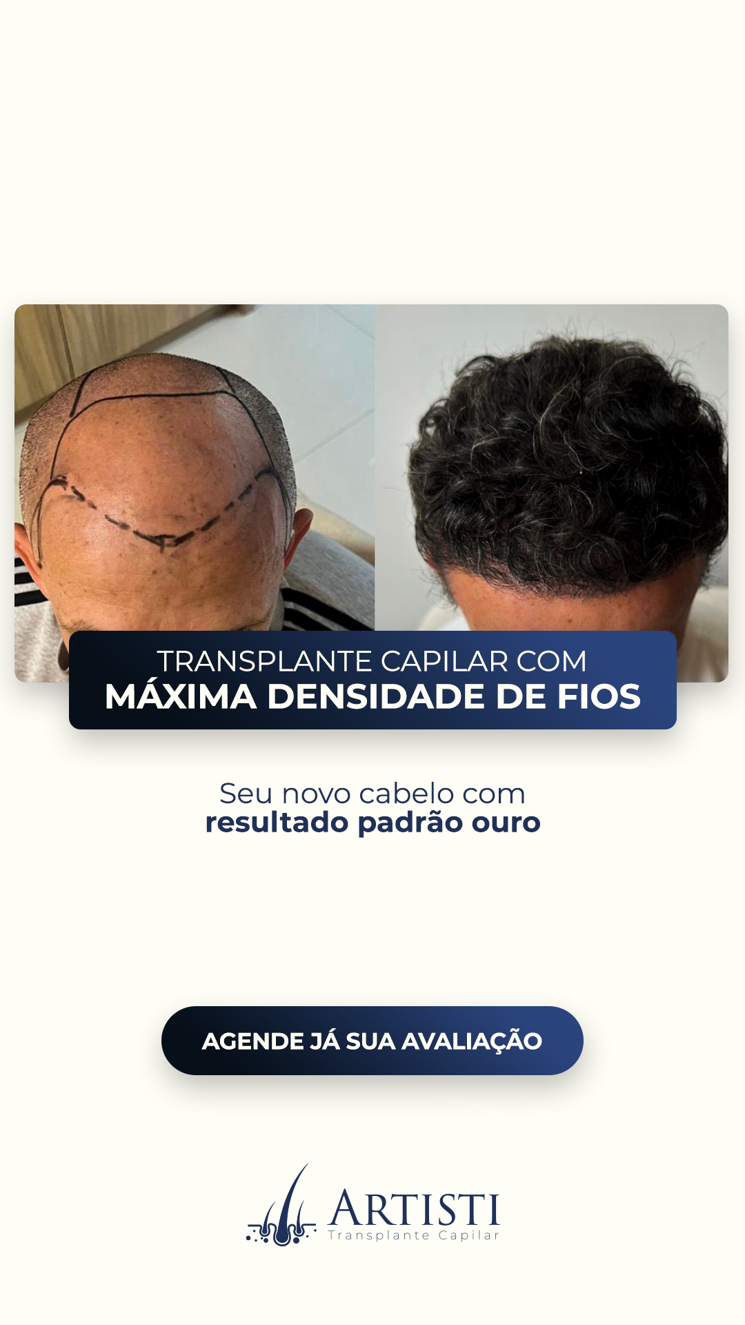 Artisti Transplante Capilar Facebook ad: Vença a Calvície