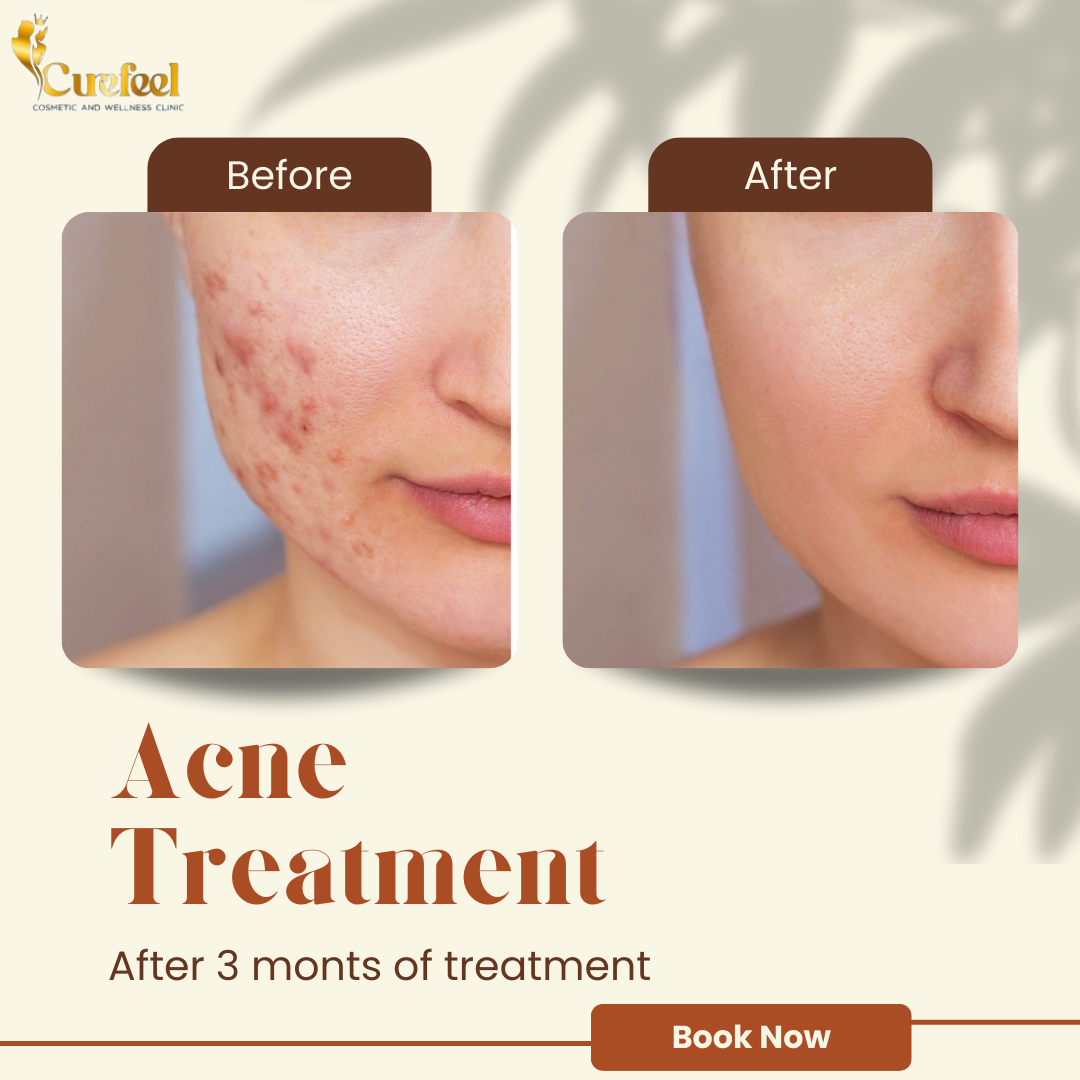 Curefeel Cosmetic Clinic Facebook ad