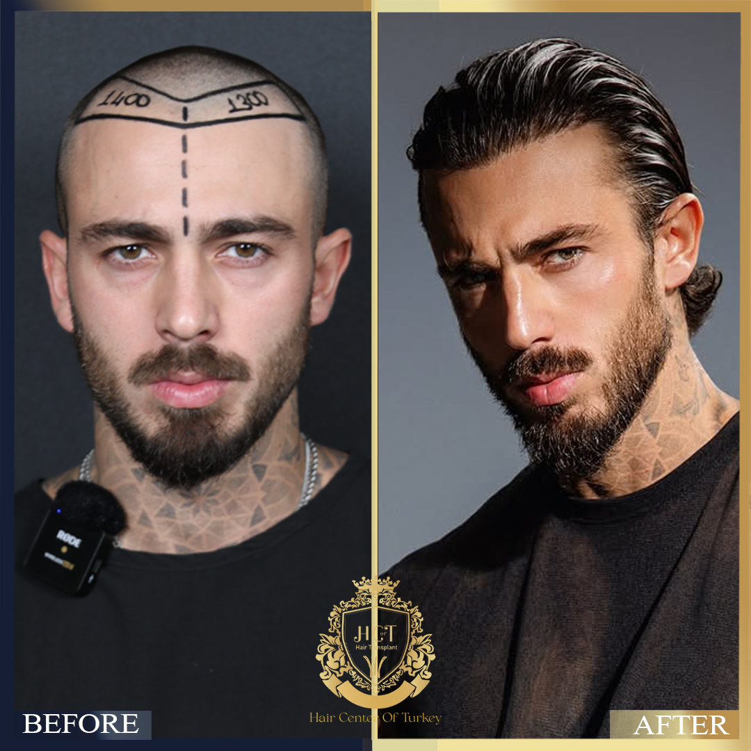 Hair Center of Turkey Facebook ad: Pacientes reales.