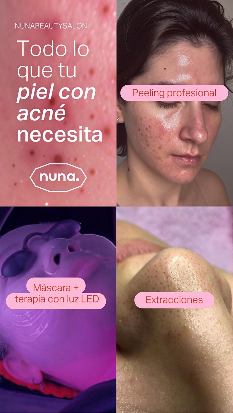 Korean Makeup Buenos Aires Facebook ad: ¿PIEL CON ACNÉ?
