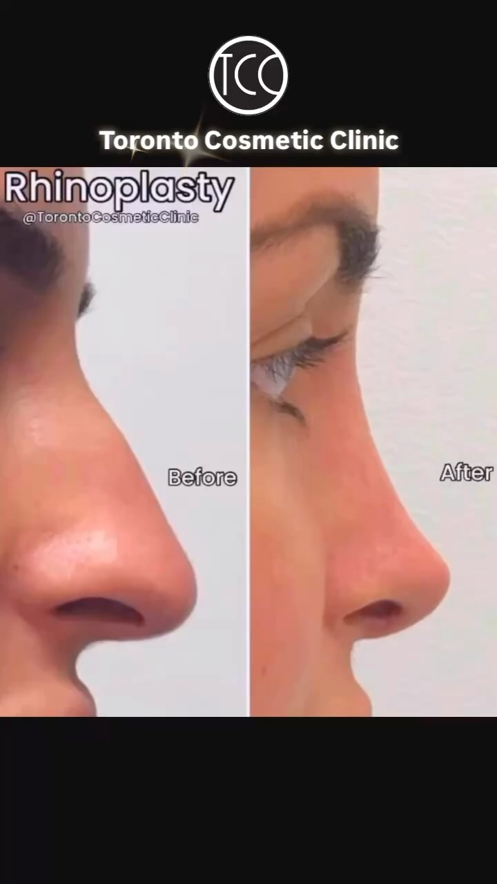 Toronto Cosmetic Clinic Facebook ad: Looking for a RHINOPLASTY in Toronto