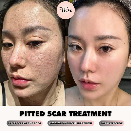 Vera Beauty Skincare Center Facebook ad: Effective after up to 89%