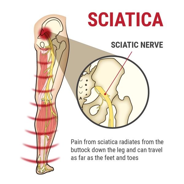 Today Disc, Bone & Joint Chiropractic Treatment Center Facebook ad: Non-Invasive & Drug-Free Sciatica Relief | Spinal…