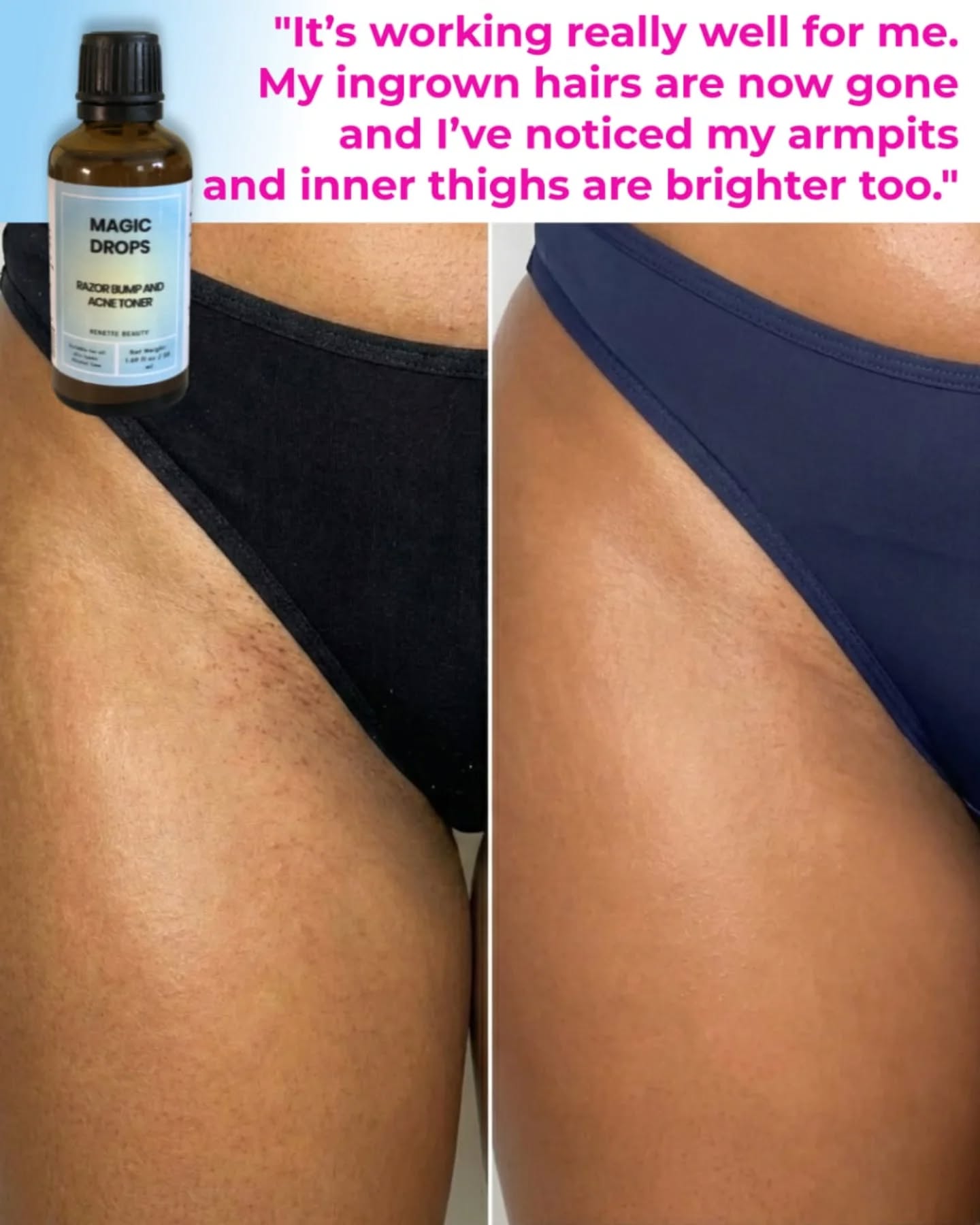 Renette beauty Facebook ad: If you struggle with razor bumps, this is…