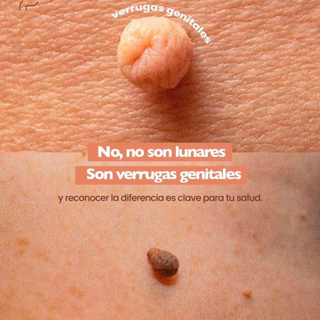 Dra Vania Herrera Facebook ad: No todo lo que parece un lunar, lo…