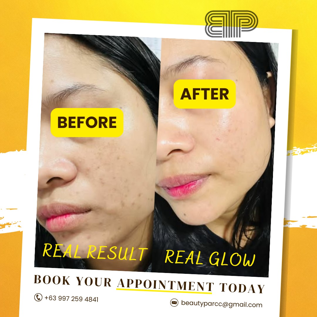 Beauty Parć Caloocan Facebook ad: From Spots to Flawless, Pico Laser Results