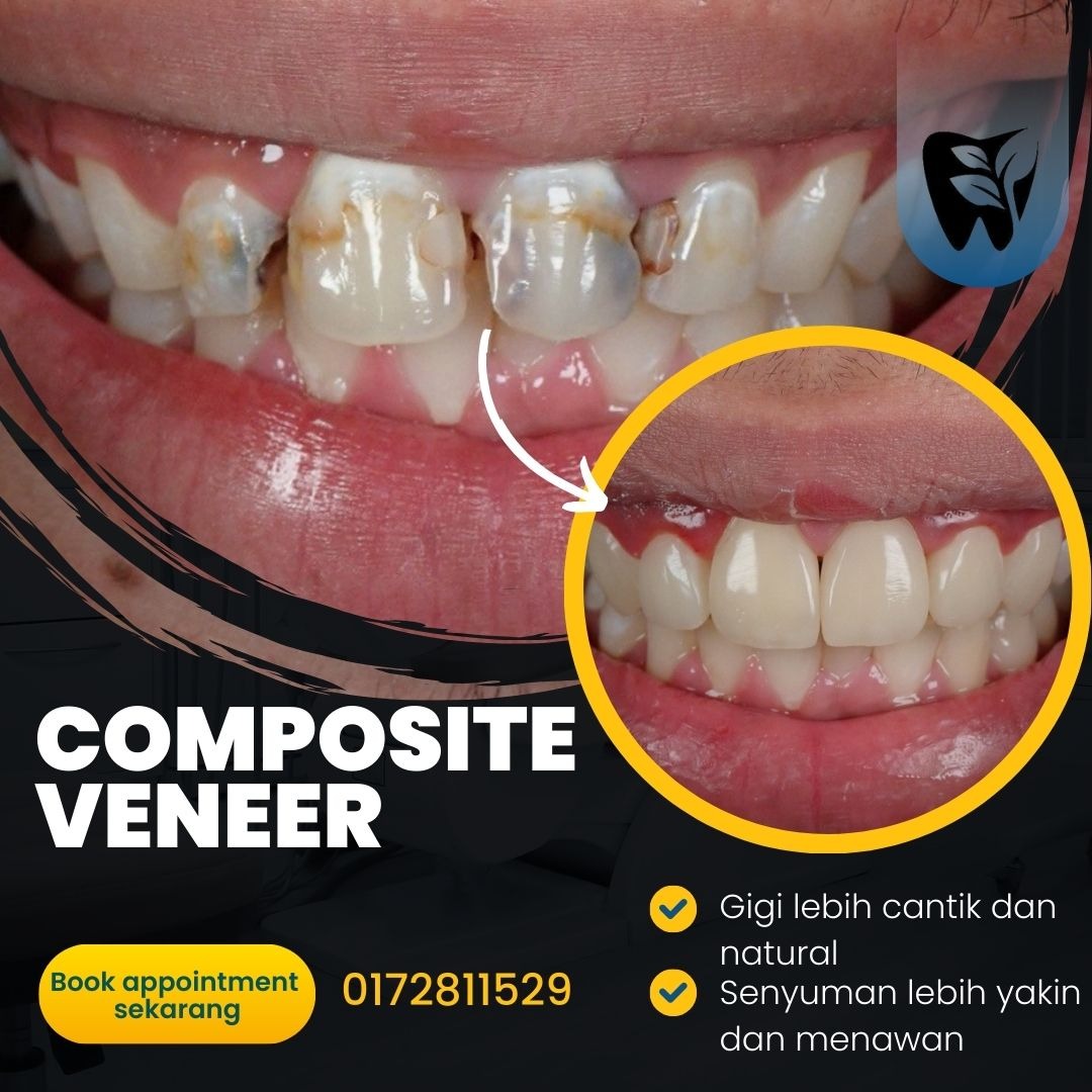 Klinik Pergigian Dr Asri Facebook ad: Cantikkan Gigi Dengan Composite Veneer