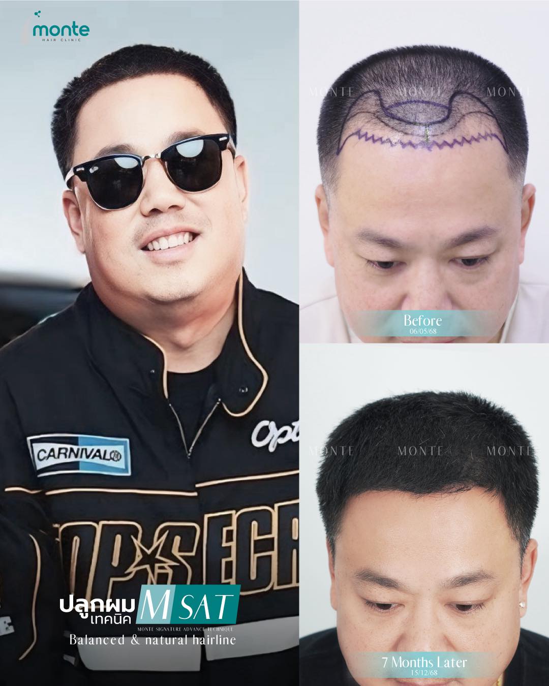 Monte Clinic - Hair Transplant ปลูกผมถาวร คิ้ว หนวดเครา รักษาผมบาง Facebook ad