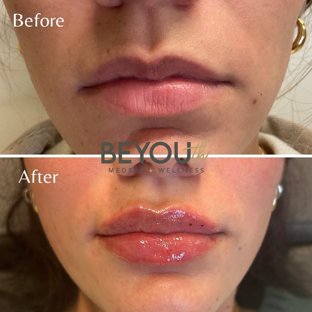 beyouthmedspa Facebook ad: A little filler goes a long way