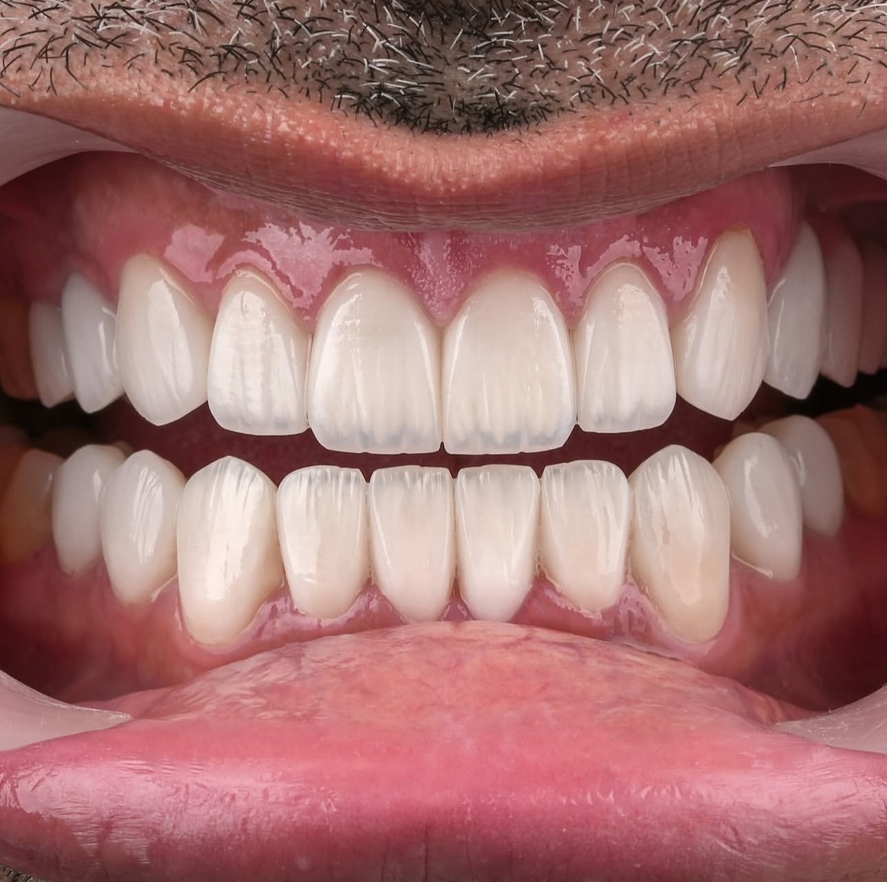 Art of smile dental center Facebook ad: NEW SMILE | facettes E-max + couronnes E-max