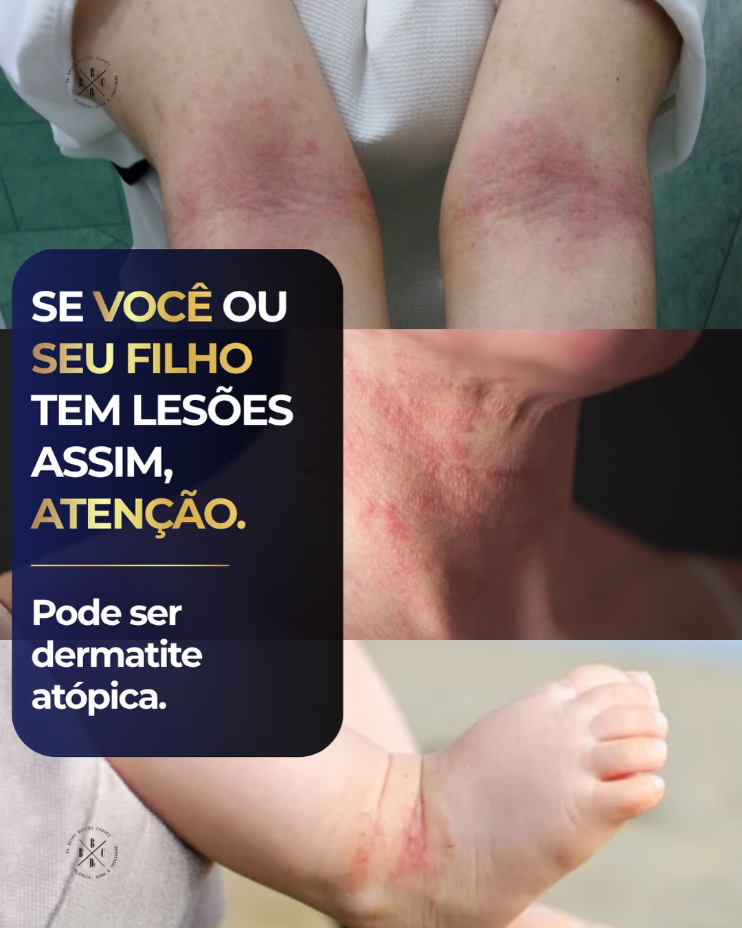 Alergista Dr Bruno Bastos Facebook ad: Pra quem tem dermatite, não é simples assim.