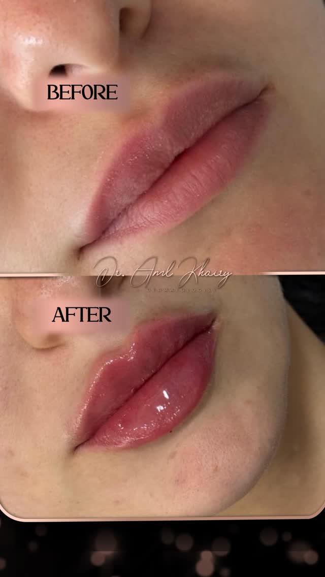 Dr. Aml Khairy Facebook ad: Soft, defined, and naturally enhanced