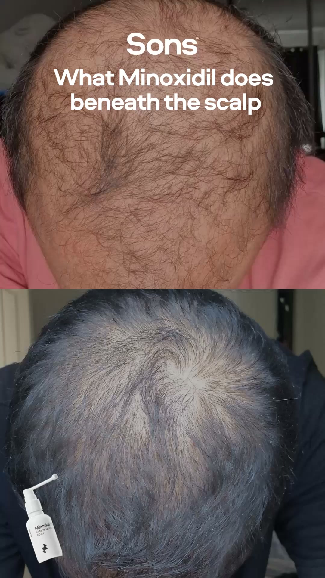 Sons Facebook ad: Your hairline. Your call.