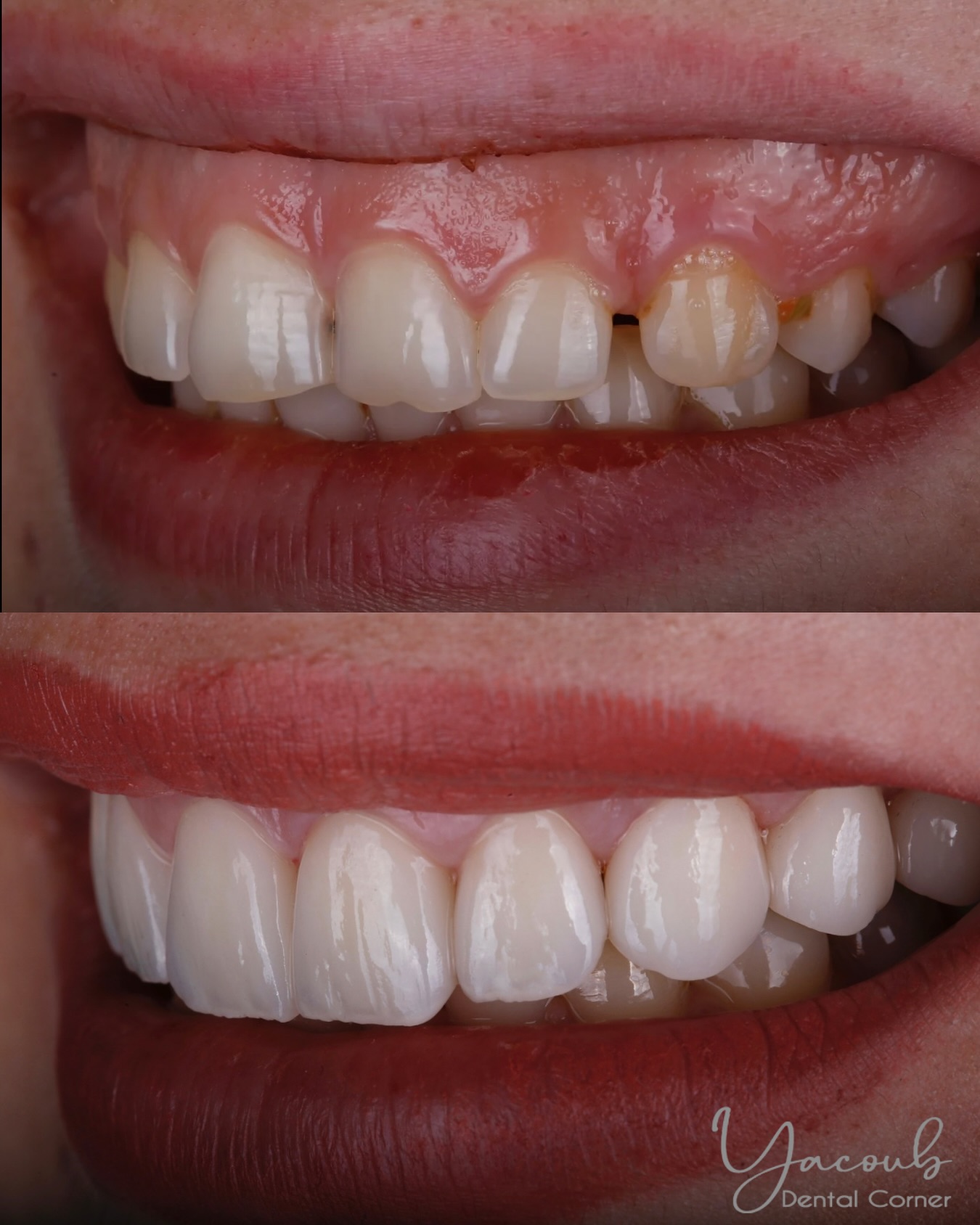 Yacoub Dental Corner - الدكتور طلال اليعقوب Facebook ad: ابتسامة قبل وبعد