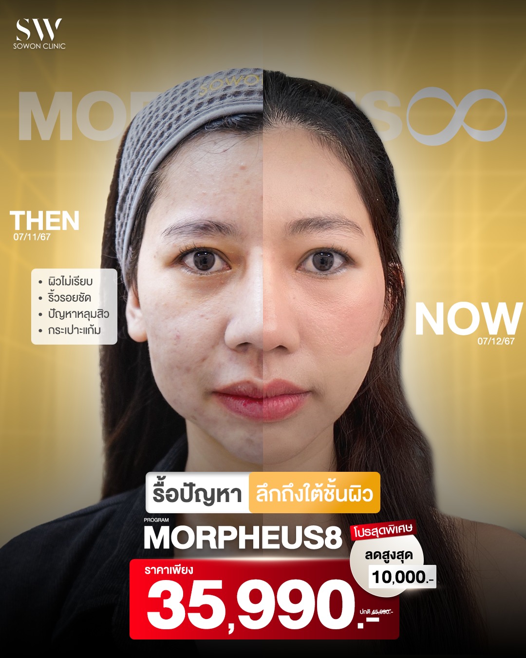 Sowon clinic Ulthera spt Radiesse Skinvive Hifu Facebook ad: รื้อปัญหา ลึกถึงใต้ชั้นผิว