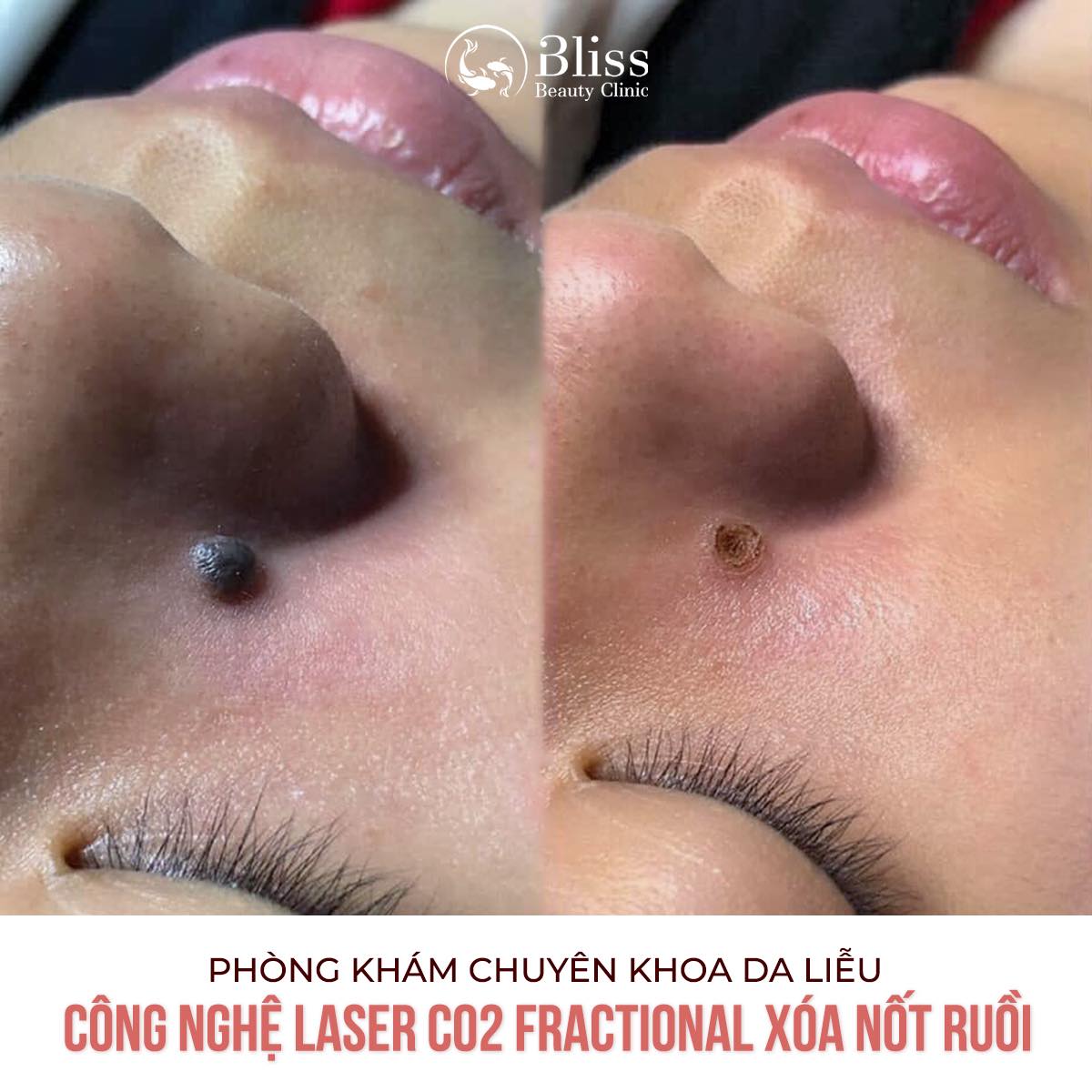 Bliss Beauty Spa Gò Vấp Facebook ad: Nốt ruồi - mụn thịt gây mất thẩm…