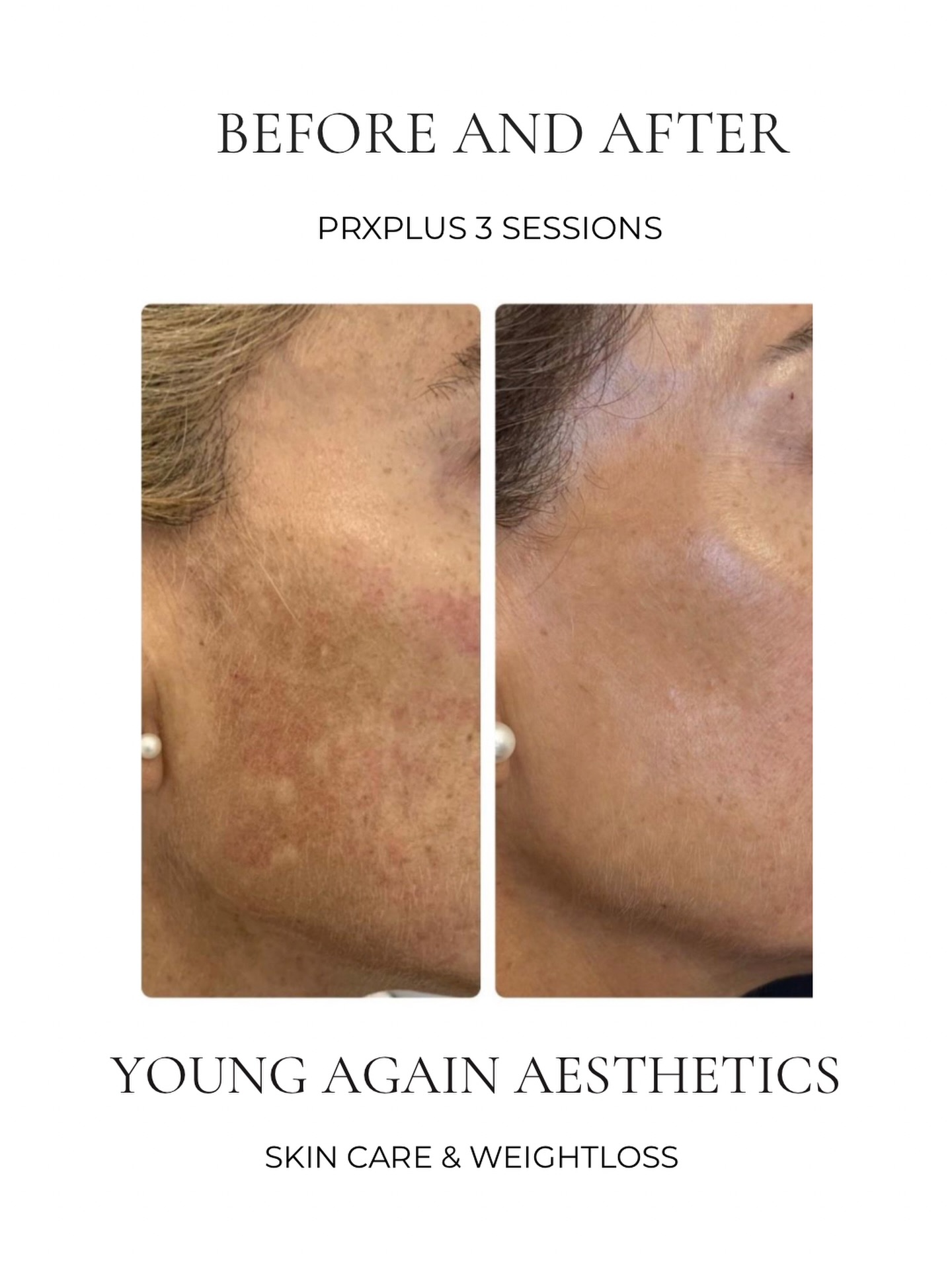 Young Again Aesthetics Sunninghill Facebook ad