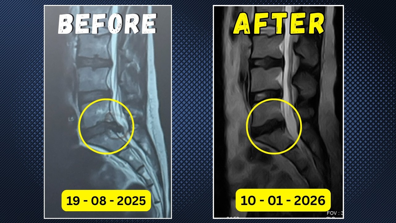 Bob The Physio Facebook ad: L5 S1 Disc Extrusion Reabsorbed without surgery in 6 months