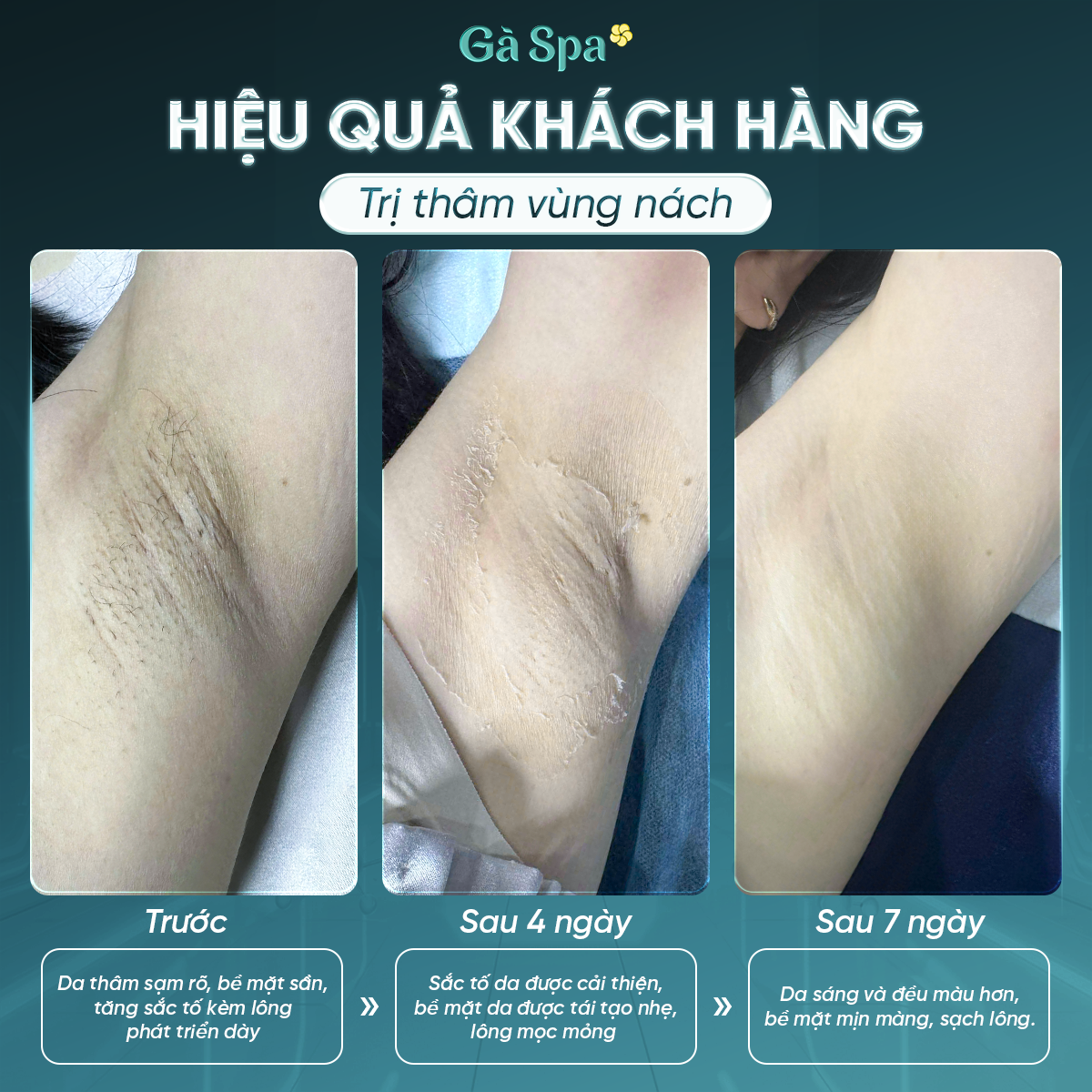 Gà Spa Thủ Đức Facebook ad: Combo Trị Thâm Sáng Da Vùng Nách =>