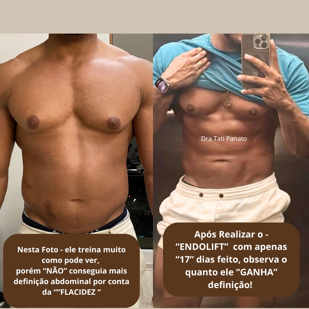 Dra.tatianepanato Facebook ad: 17 dias após a Realização do Endolift!