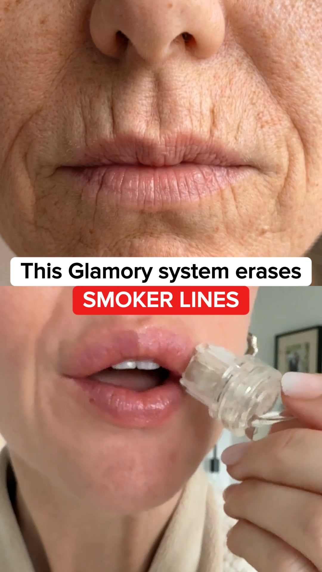 My Glamory Obsession Facebook ad: At-Home Botox Results, Without Needles