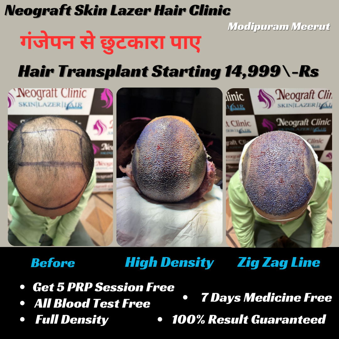 NeoGraft Hair Transplant Clinic Facebook ad: Hair Transplant Services In Modipuram Meerut