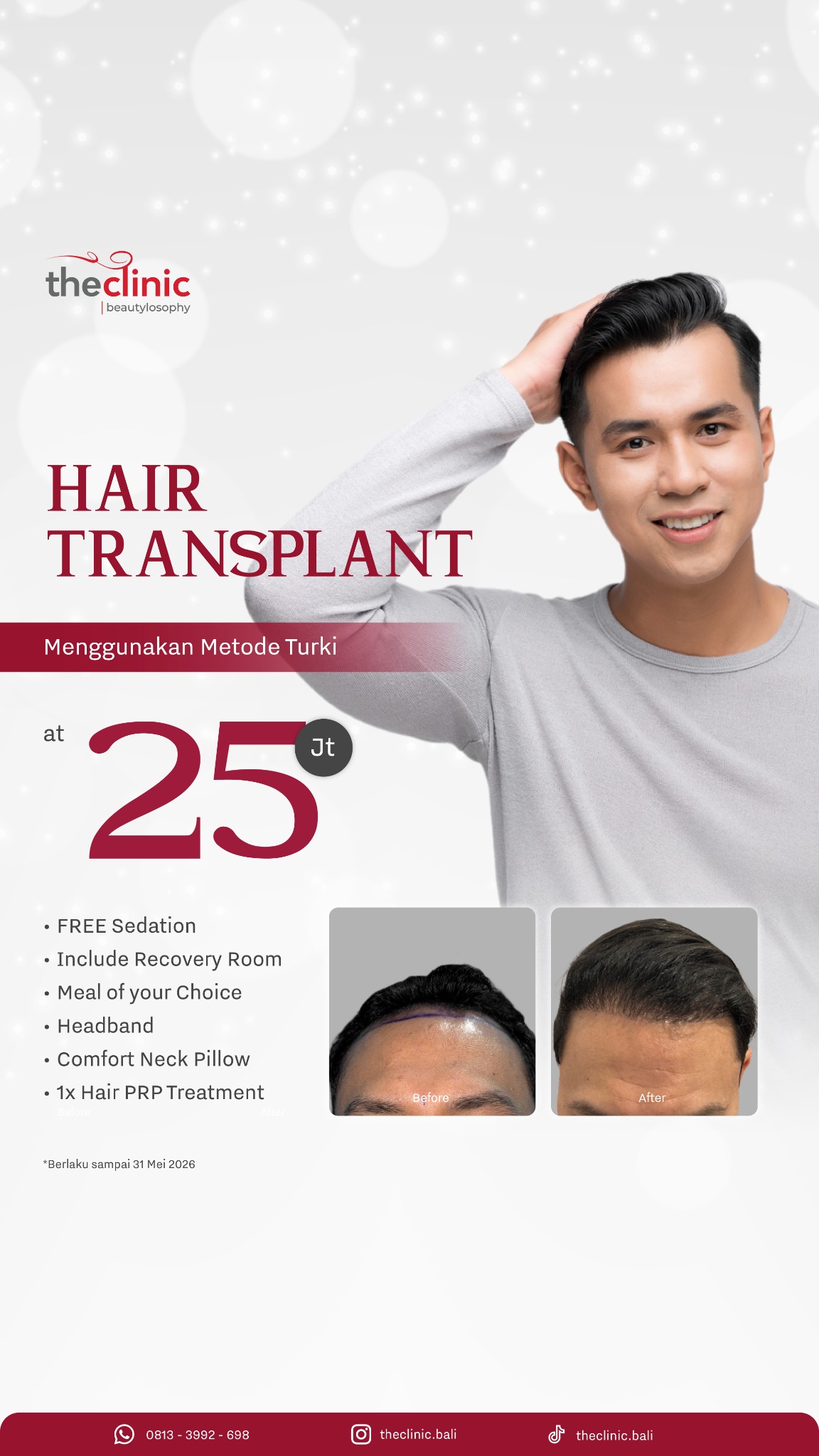The Clinic Bali Facebook ad: Hair Transplant Metode Turki Kini di Bali!