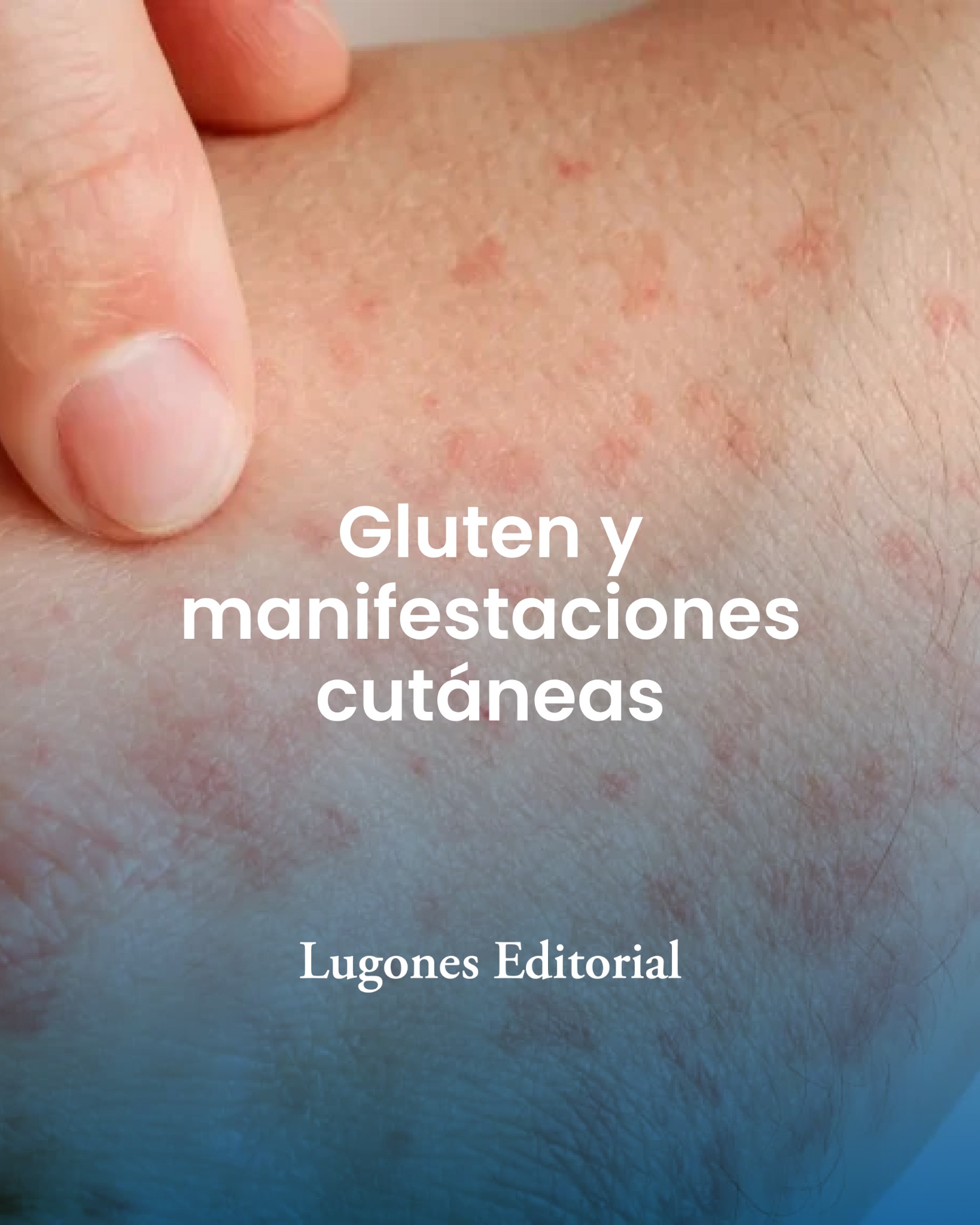 Lugones Editorial Facebook ad: Gluten y manifestaciones cutáneas