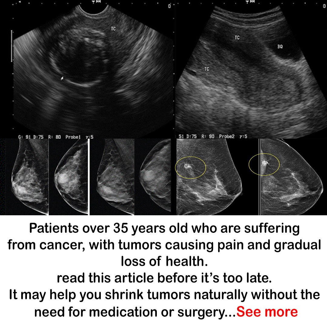 Dr. Adel Elemia Facebook ad: A way to make a tumor shrink naturally without using…