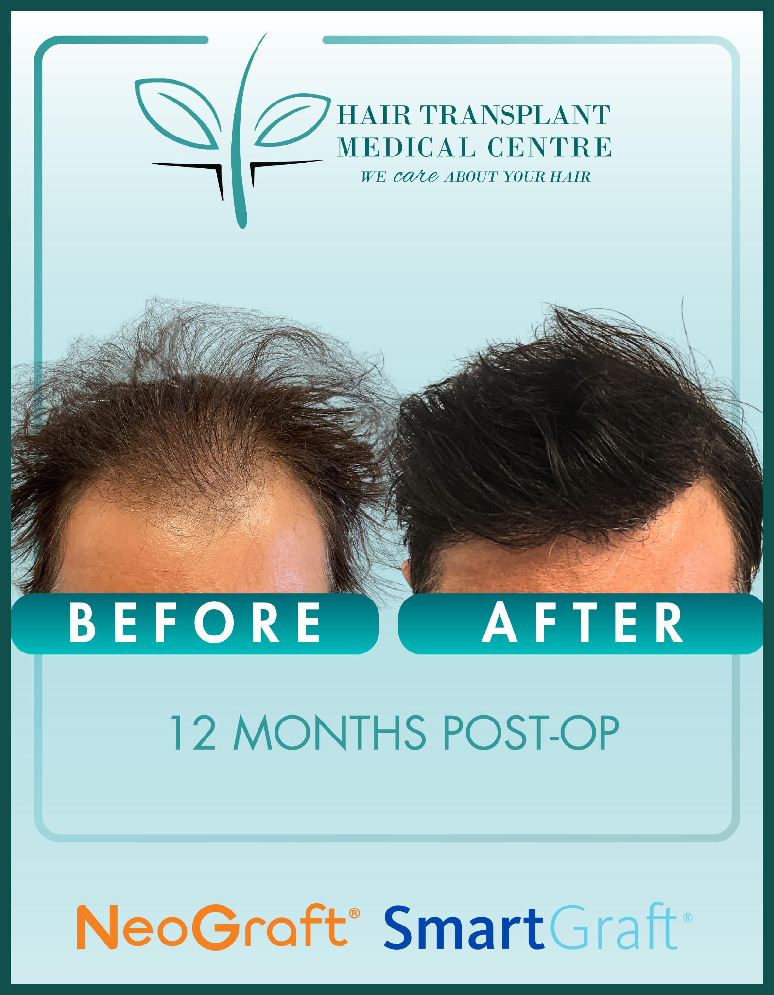 Hair Transplant Medical Centre Facebook ad
