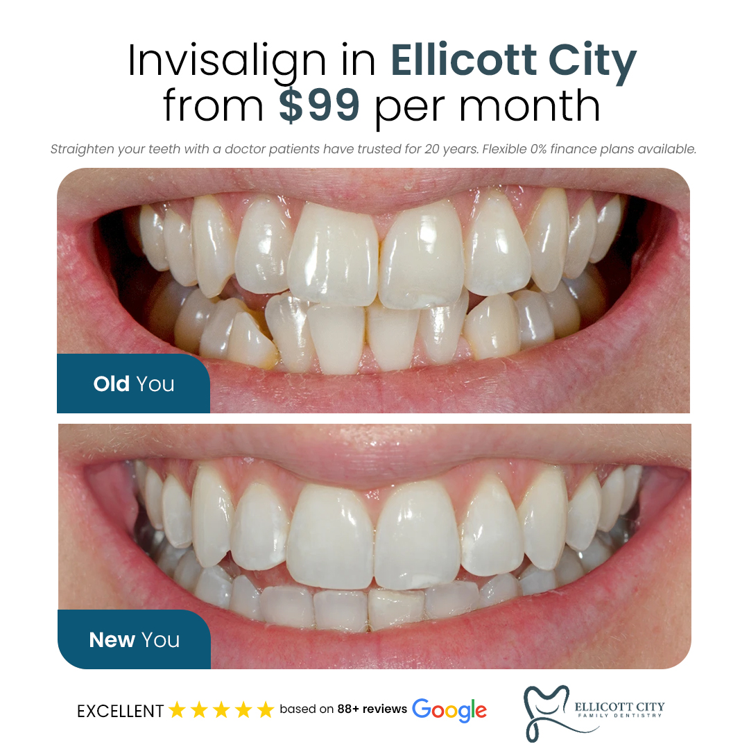 Ellicott City Family Dentistry Facebook ad: Book Your FREE Invisalign Consultation