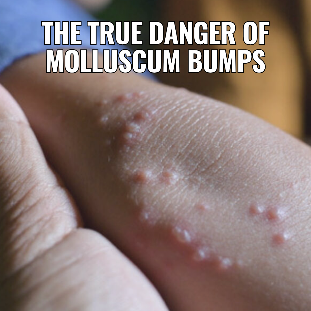 Orvele Facebook ad: Heal Molluscum Before Contamination