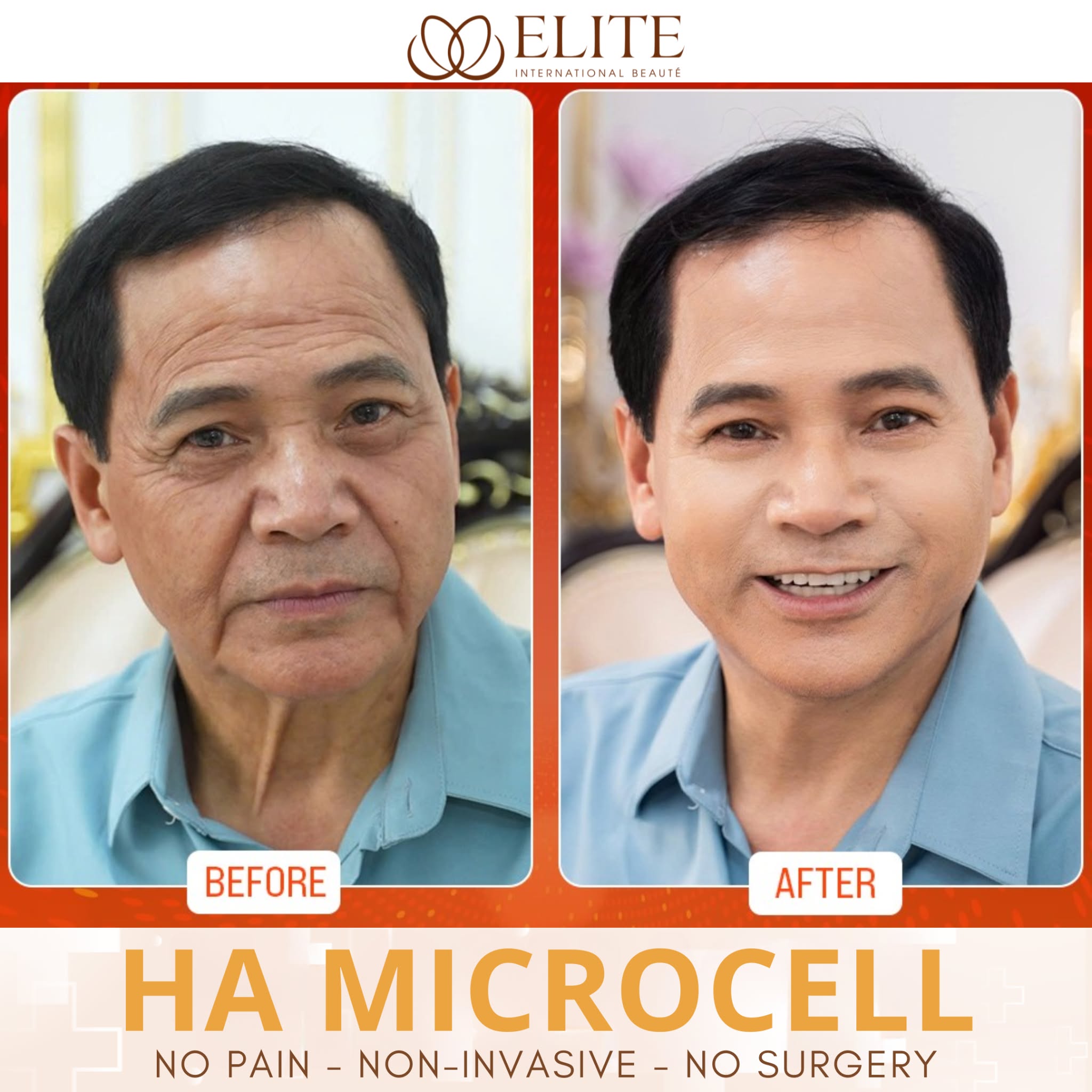 ELITE International Aesthetic Institute - Laguna Branch Facebook ad