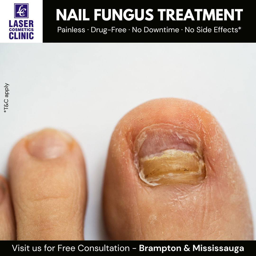 Adviuz Facebook ad: 6 Reasons Why you should choose Laser Treatment for Nail…