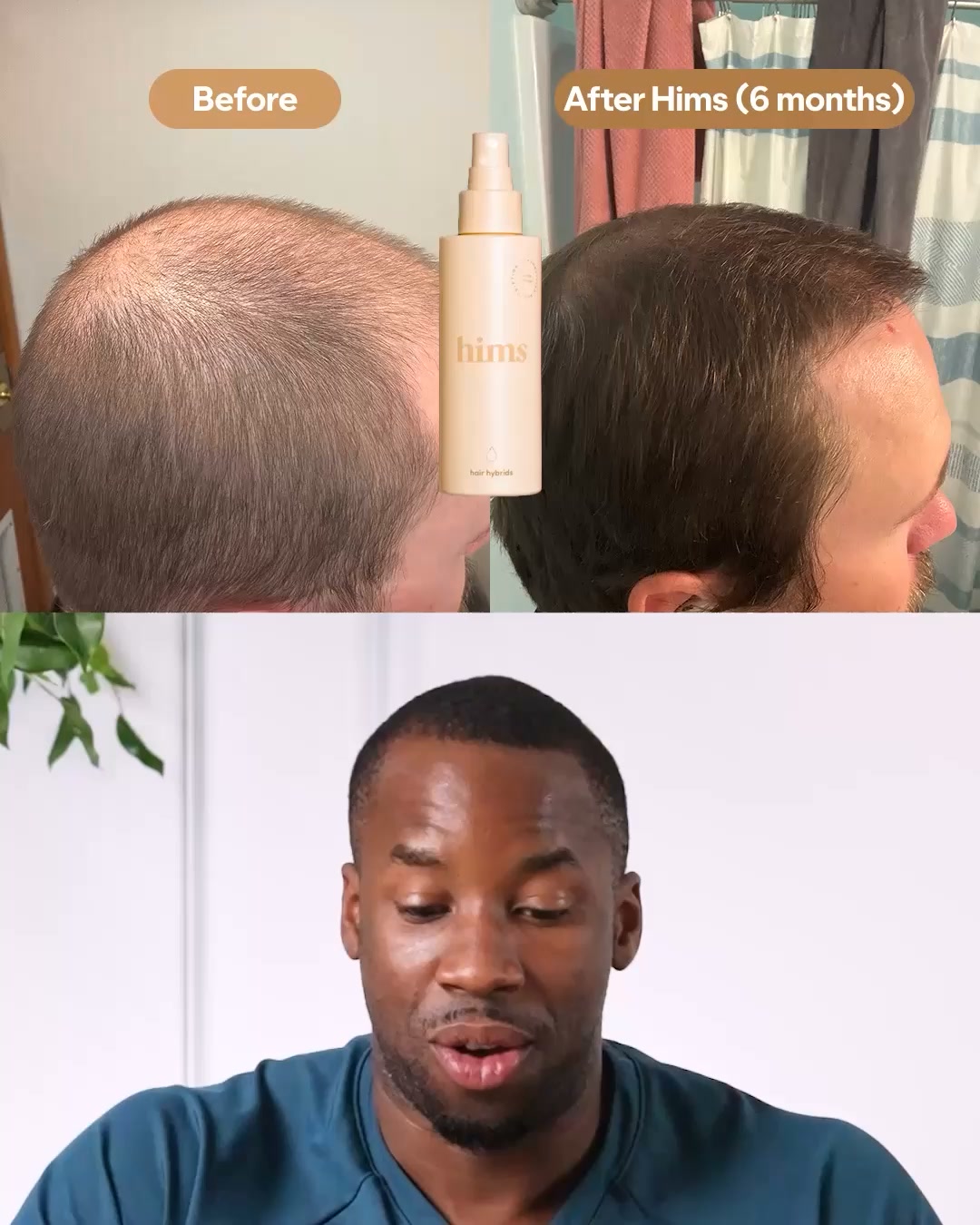 hims Facebook ad: Personalised Hair Regrowth Treatment