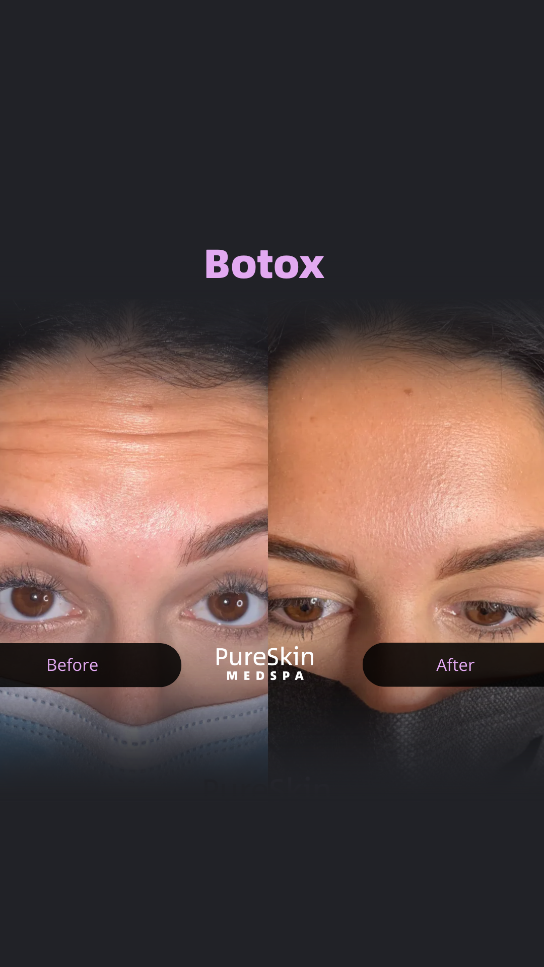 Pure Skin Facebook ad: CT MedSpa | Botox