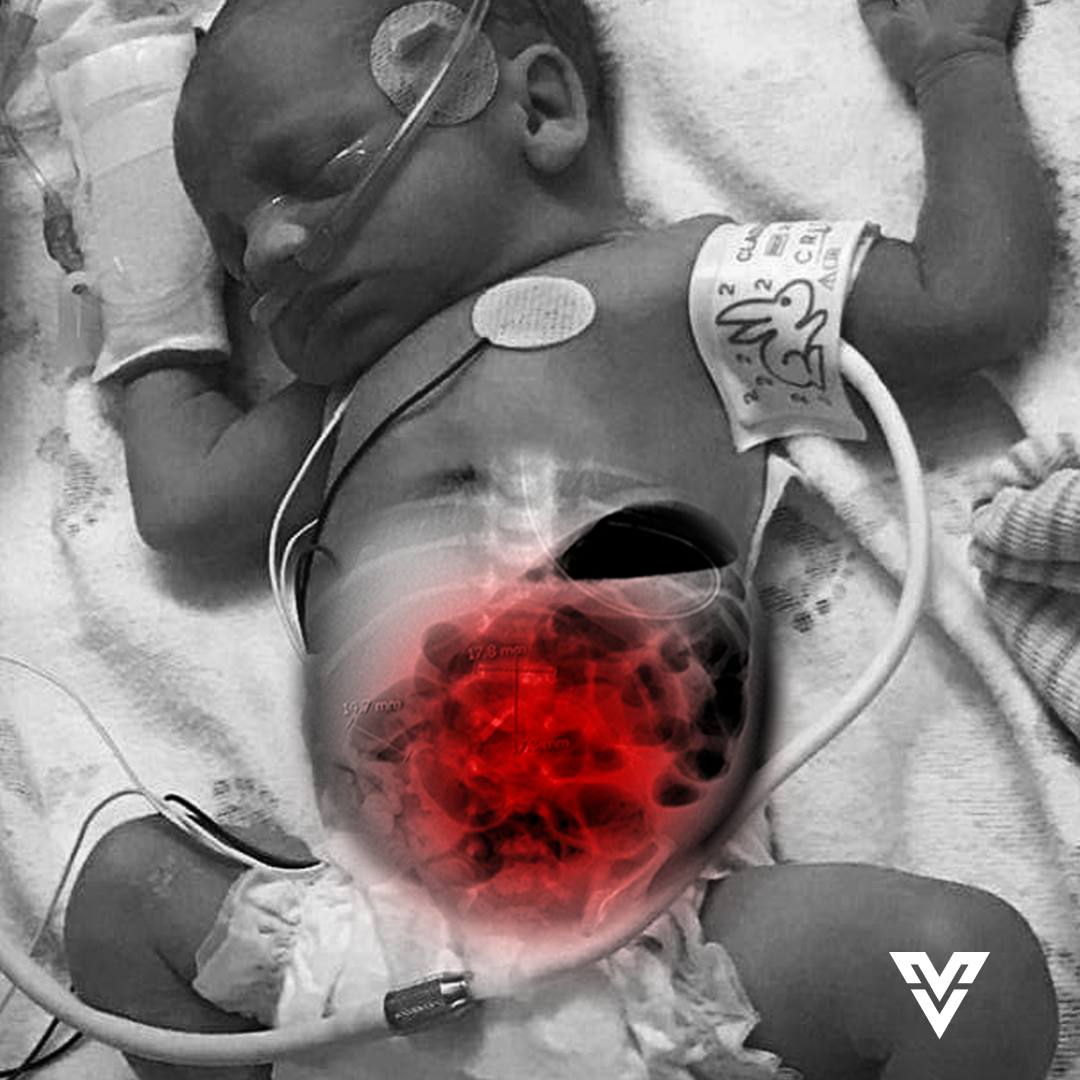 The Flynn Law Firm Facebook ad: Premature Babies w/ NEC Entitled to Compensation