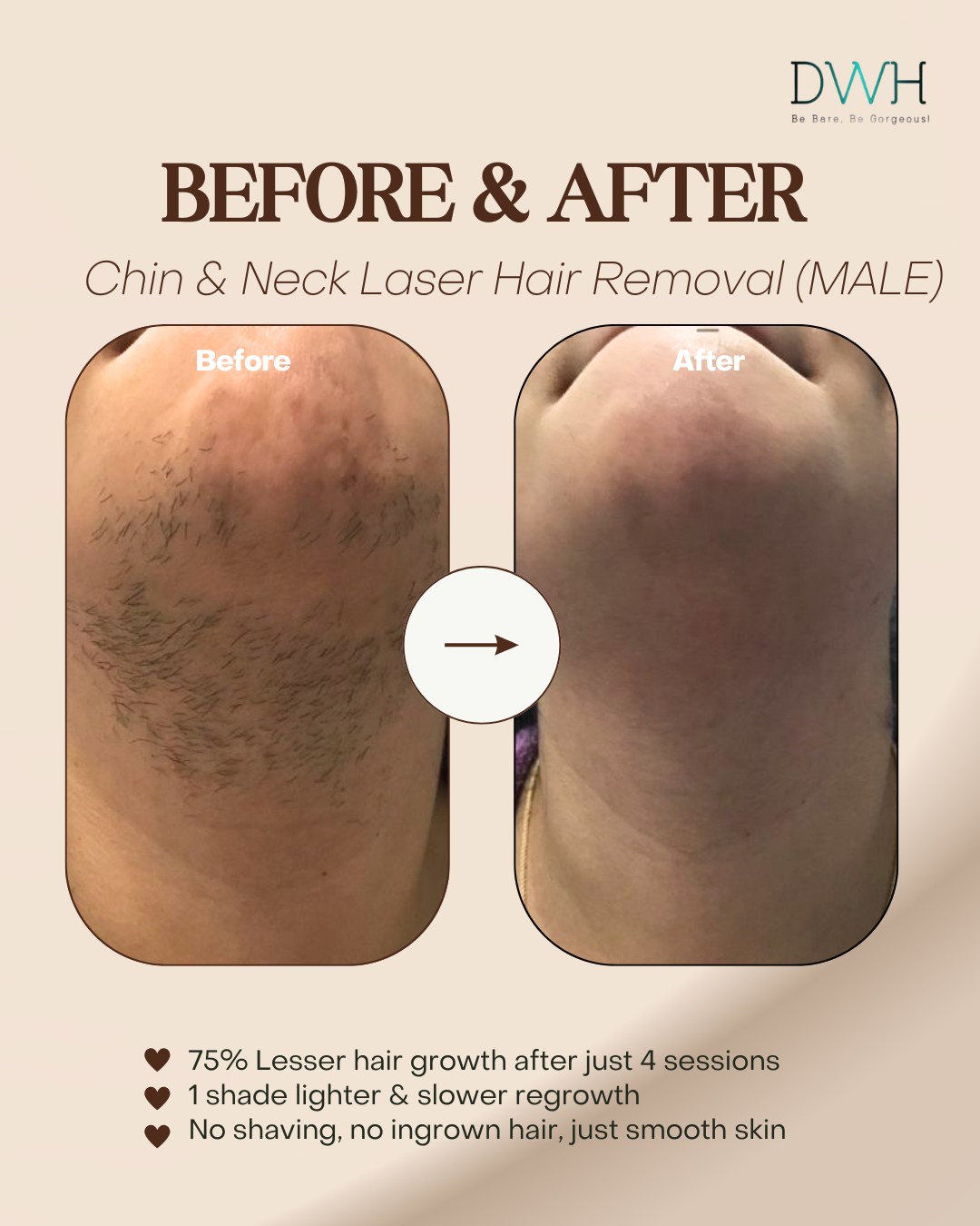 DWH Beauty Center Facebook ad: Did you know you can achieve 95% permanent…