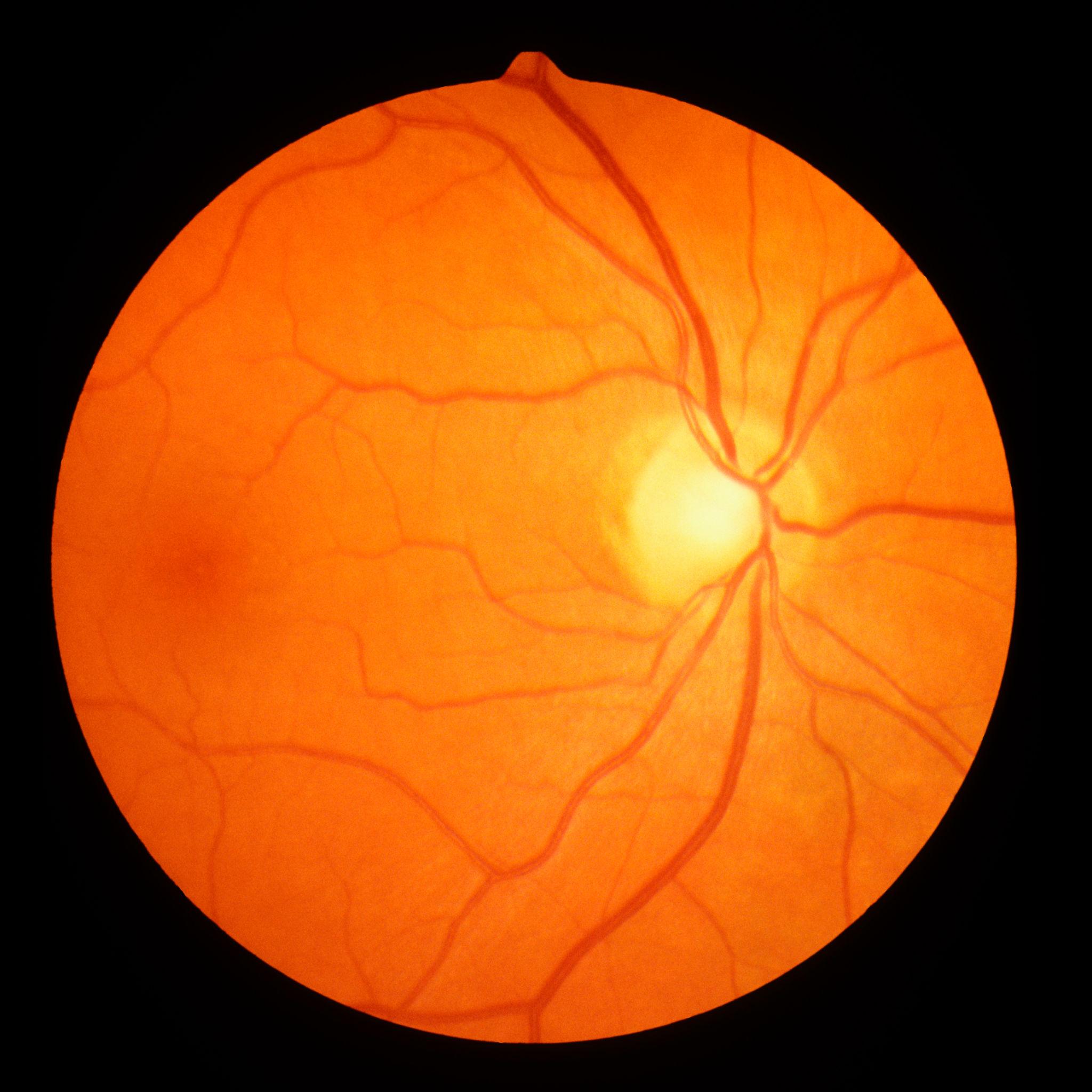 Liam Berg Facebook ad: Click here and stop Diabetic Retinopathy tomorrow