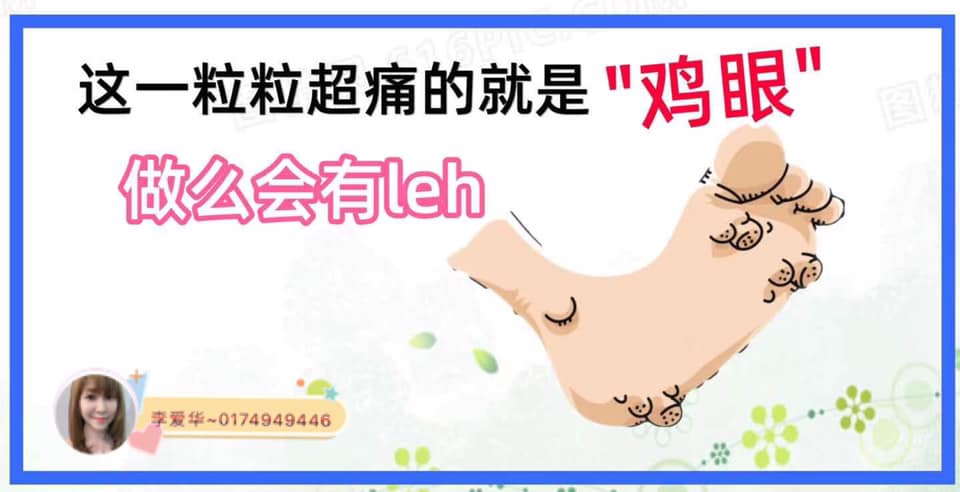 衍恩堂医用冷敷贴 Facebook ad: 鸡眼都听说过吧