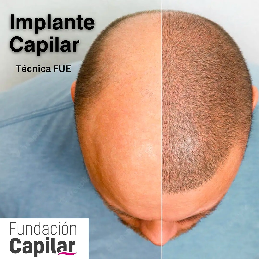 Fundación Capilar - Implante Capilar Facebook ad from Jul 25, 2026